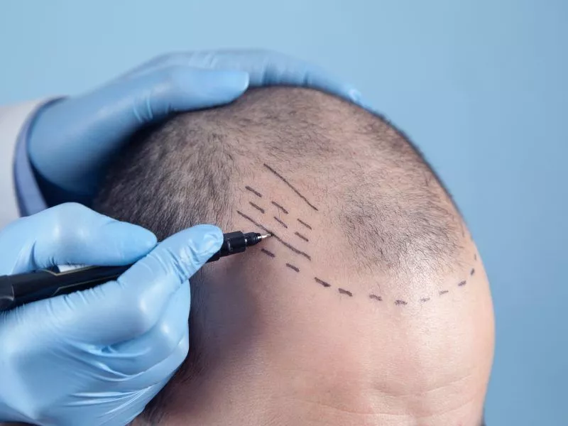 The Truth about Permanent, Safe, and Natural Results of FUE Hair Transplants